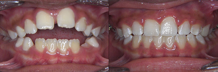 Early Treatment (Phase One): Anterior open bite due to thumb habit.