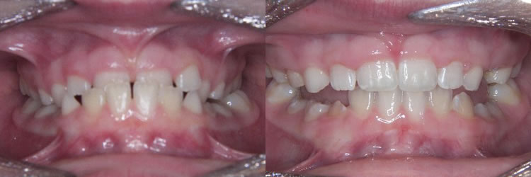 Early Treatment (Phase One): Class III (underbite) with anterior and posterior left crossbite.