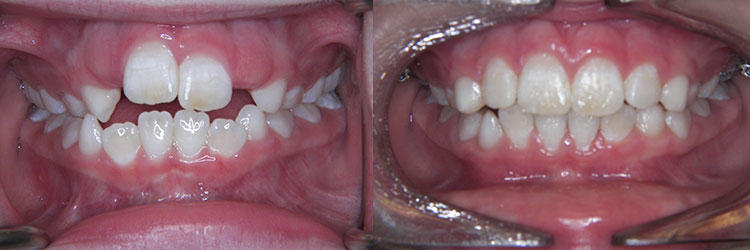 Early Treatment (Phase One): Crowding and narrow arches with anterior open bite.
