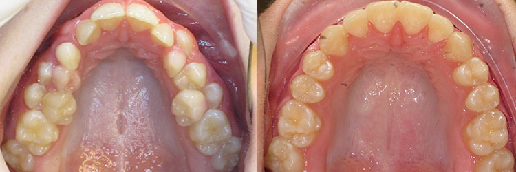 Teen Treatment: Crowding with retained primary teeth and narrow arch.