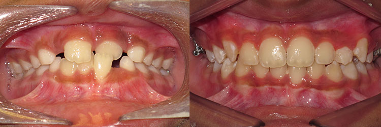 Early Treatment (Phase One): Crowding with narrow arches and anterior single tooth crossbite.